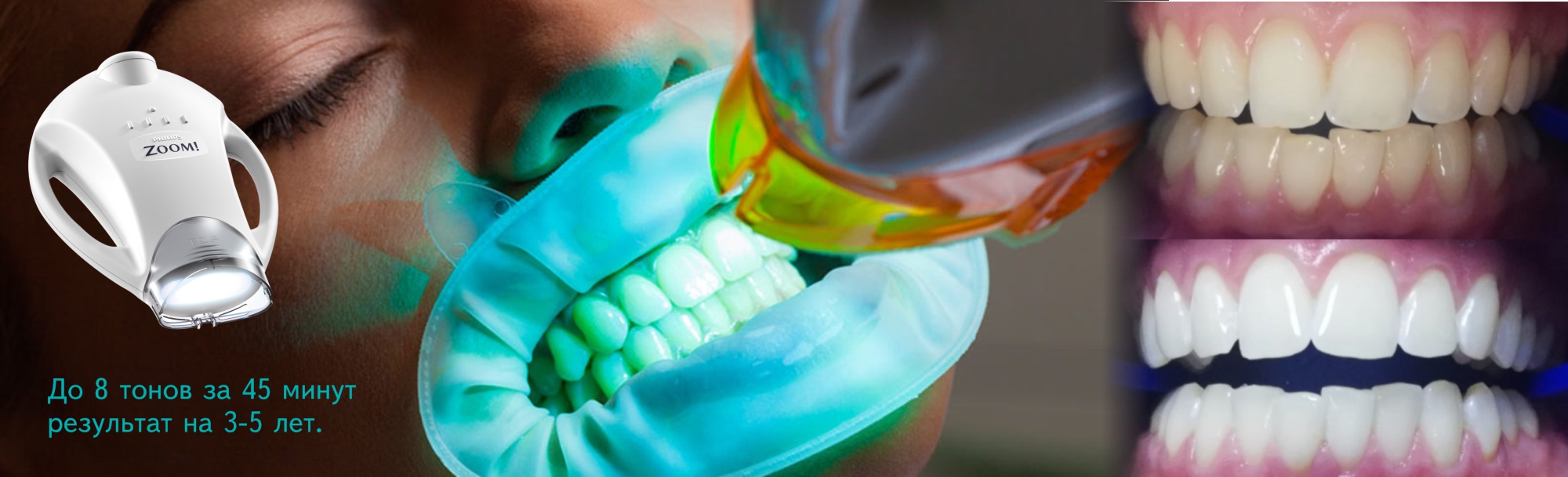 тбеленные системой зубы